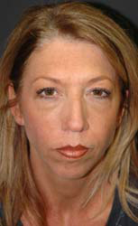 Eye Lift - Patient 1 - Before